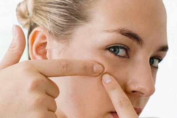 挤痘痘的坏处有什么？为什么不能挤痘痘