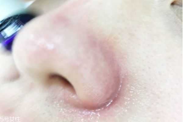 如何消除鼻翼两侧发红 鼻翼两侧发红有血丝