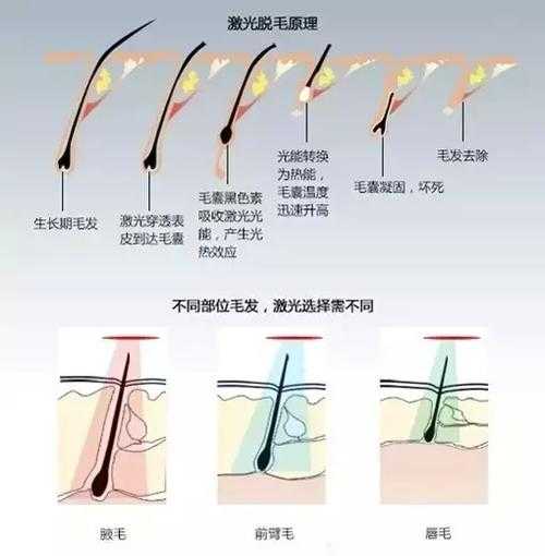 女生未满十八岁可以激光脱毛吗