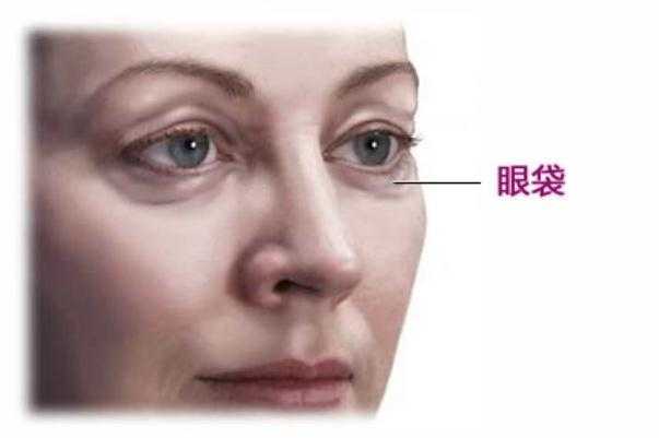 眼袋能热敷吗?眼袋是热敷还是冷敷 眼袋能热敷吗?眼袋是热敷还是冷敷