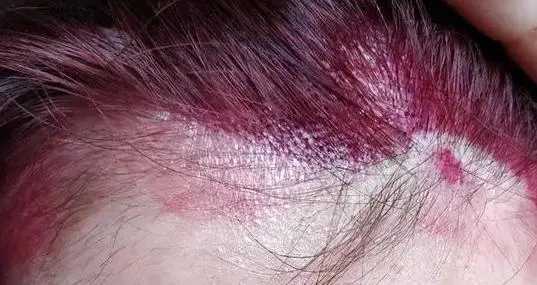 染发剂弄到皮肤多少天才能掉