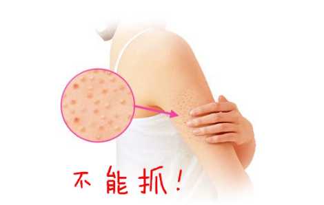 去鸡皮肤用什么好