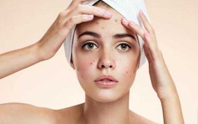 为什么女生会长麻子?女生长麻子的原因是什么 为什么女生会长麻子?女生长麻子的原因是什么