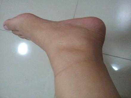 脚踝浮肿是什么原因引起的 脚踝浮肿是什么原因引起的