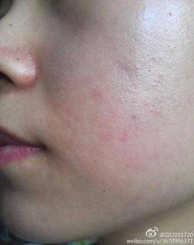 洗面奶过敏有什么症状？什么样子的？