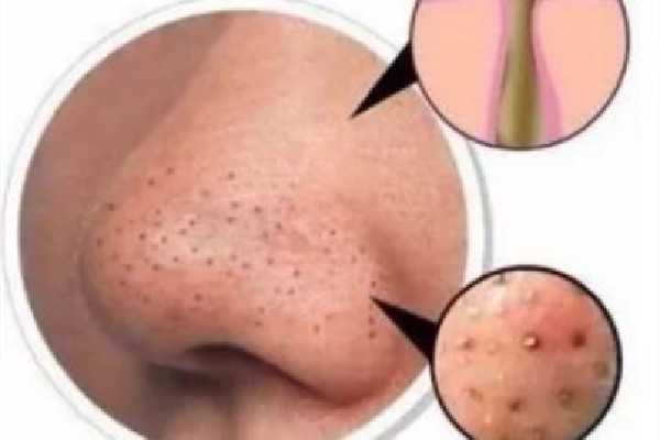 去黑头在面膜前还是后