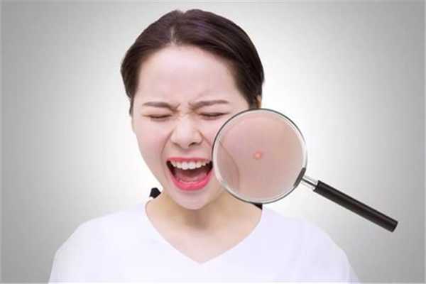 夏天脸上长痘痘怎么回事?为什么夏天脸上爱长痘 夏天脸上长痘痘怎么回事?为什么夏天脸上爱长痘