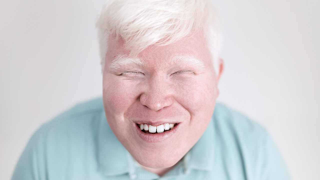 脸干燥脱皮怎么办？脸干燥脱皮的护理方法