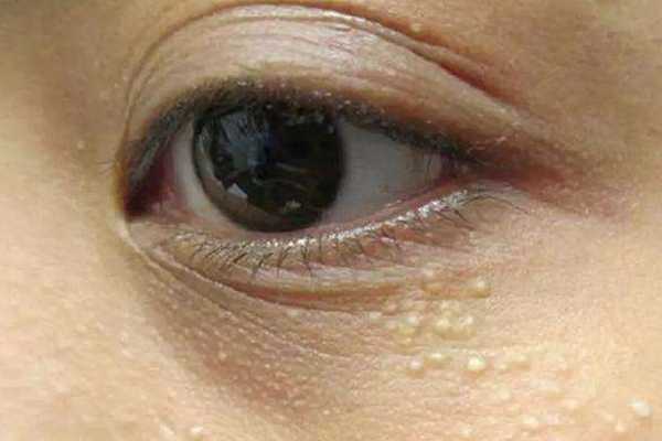 去脂肪粒的药膏叫什么 去脂肪粒的药膏叫什么