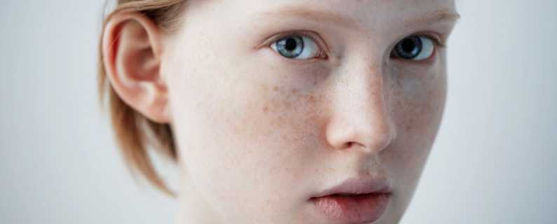 脸上为什么有斑 脸上为什么有斑