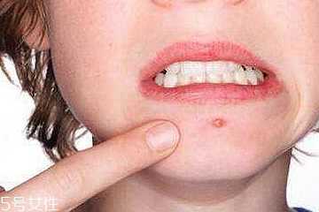 红肿痘痘怎么快速消肿