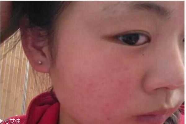 为什么脸上容易有红血丝