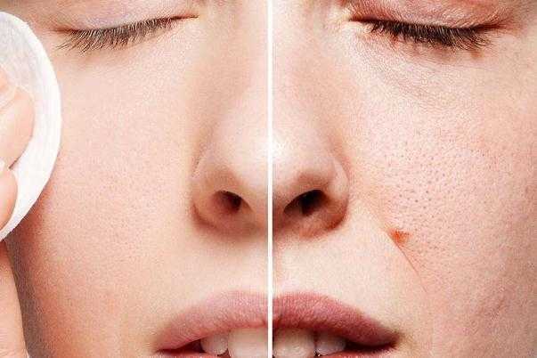 毛孔粗大会自己好吗