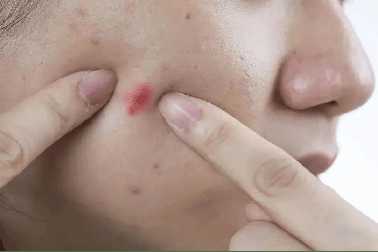 痘印痘坑难消除？这个方法强烈建议你试试