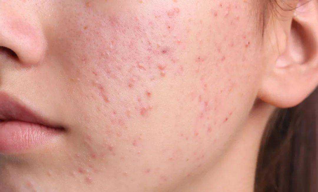 如何科学有效地祛痘印呢 如何科学有效地祛痘印呢