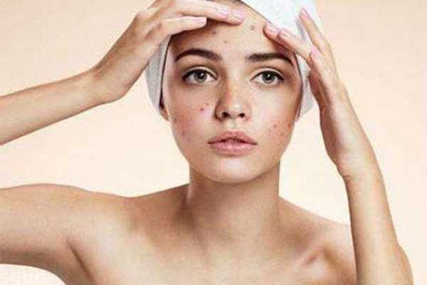痘痘肌怎么护理