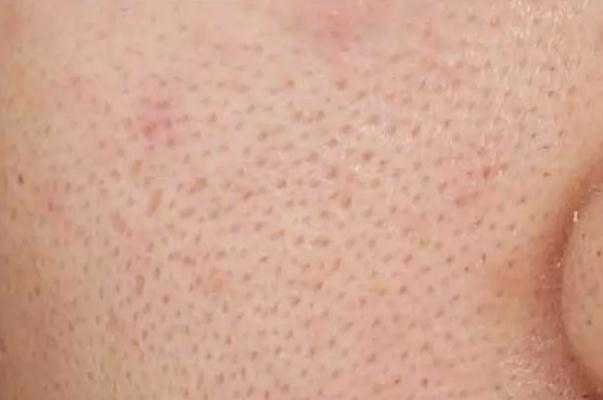 毛孔粗大有黑头怎么办 毛孔粗大能修复吗