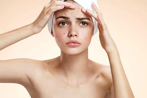 防晒霜闷痘能消下去吗 防晒霜闷痘能消下去吗