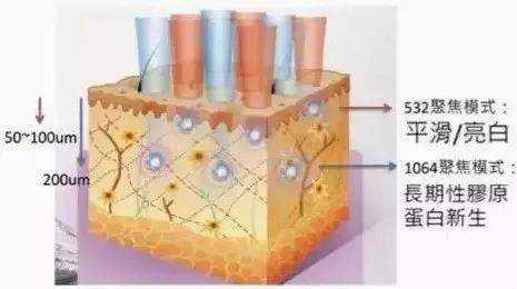 超皮秒祛斑做一次就有效果吗