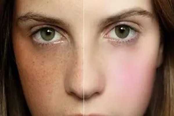 玫瑰花能去除黄褐斑吗 玫瑰花能去除黄褐斑吗