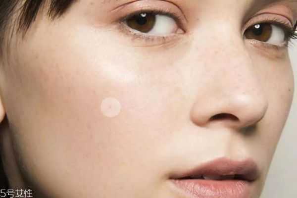 为什么额头上长很多小痘痘