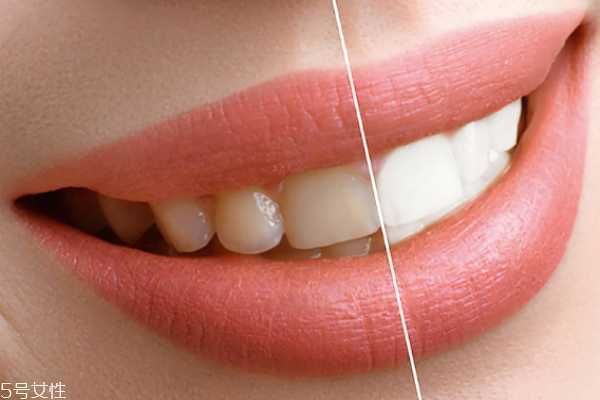 佳洁士电动牙刷好用吗 给牙齿做个美白spa