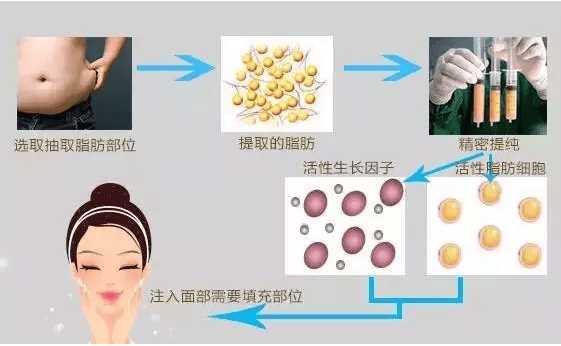 做脂肪填充全脸好吗？多久可以恢复