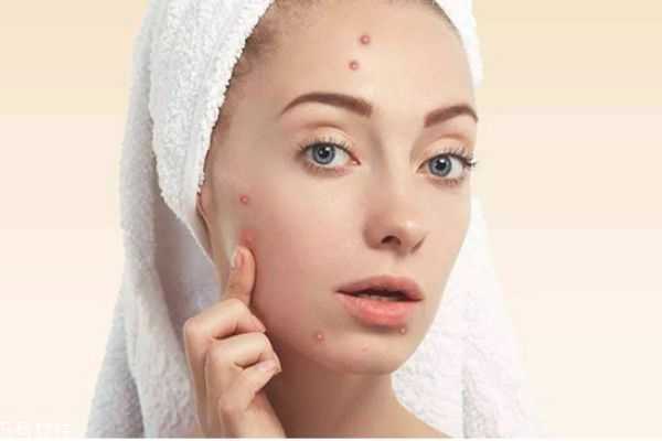 使用水杨酸为什么会爆痘