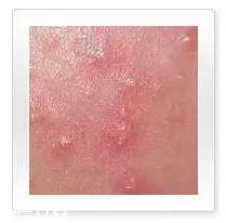 平衡露什么成分能祛痘