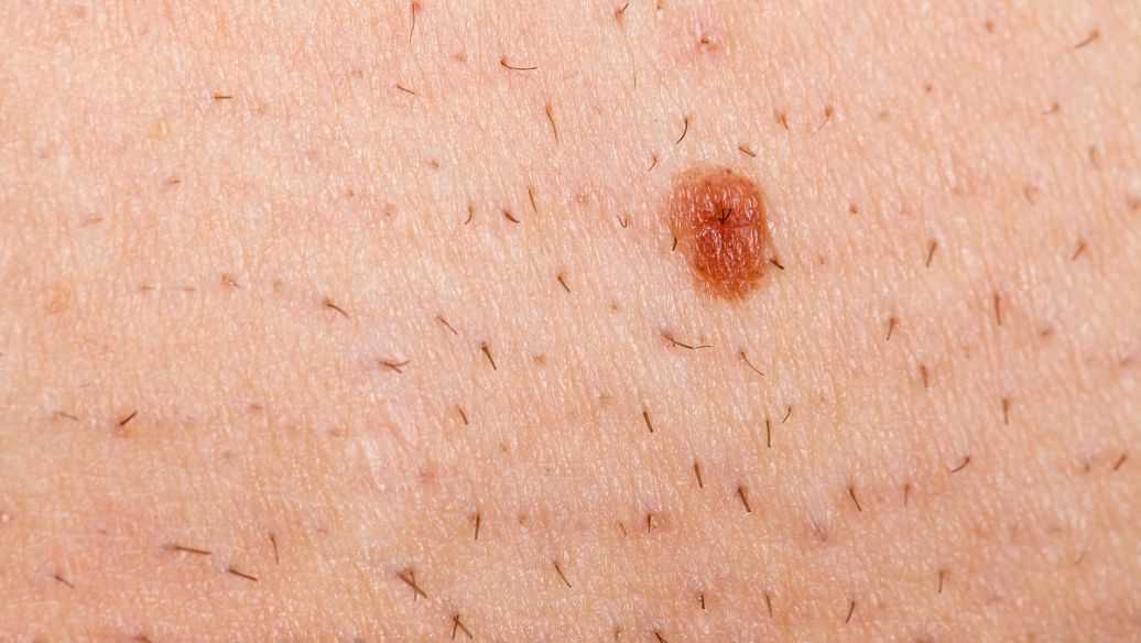 痤疮粉刺怎么治 痤疮粉刺怎么治