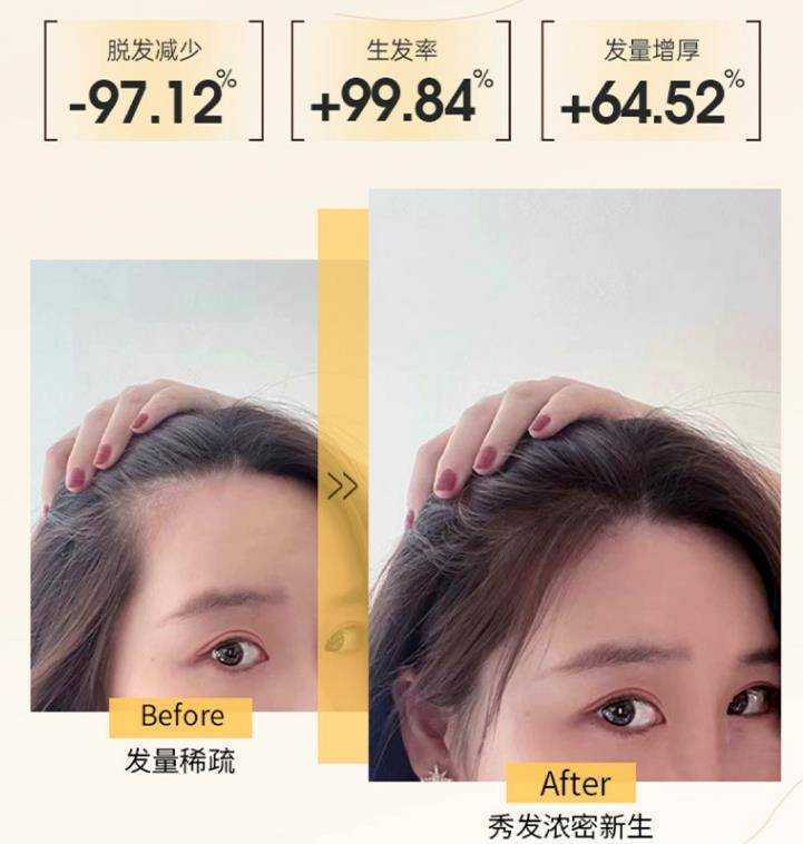 脱发严重应该用什么洗发水?