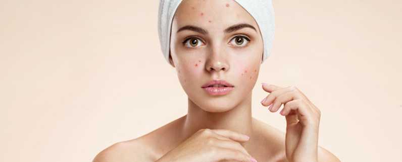 封闭性粉刺怎么治疗 封闭性粉刺怎么治疗