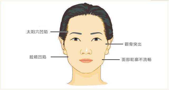 做脂肪填充全脸好吗？多久可以恢复