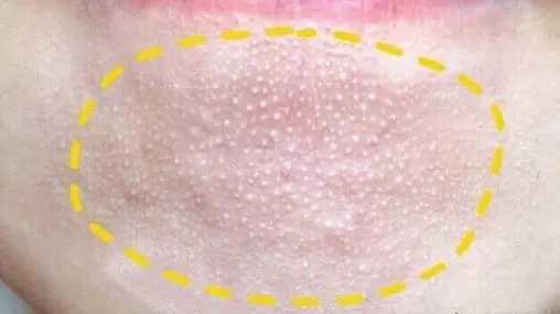 什么是闭口粉刺