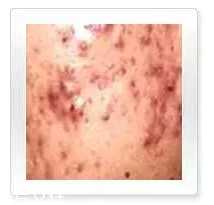 平衡露什么成分能祛痘