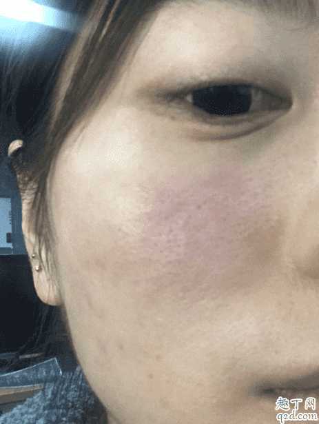 sk2神仙水用了为什么会刺痛？神仙水330ml瓶子里有水雾怎么回事