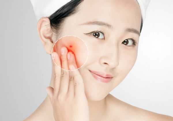 狮王祛痘膏怎么用 狮王祛痘膏怎么用