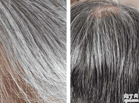 白头发太多怎么解决?长白发能变黑吗 白头发太多怎么解决?长白发能变黑吗