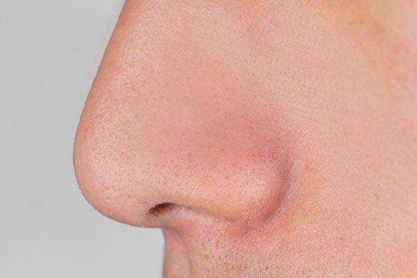 鼻子里总能挤出的“小白条”是什么？怎么能够快速去除？ 