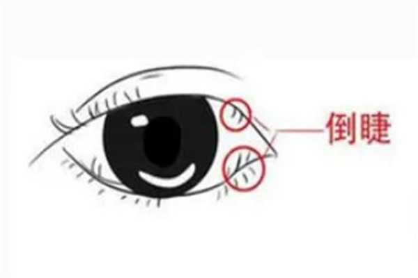 下眼睫毛贴在眼球上怎么办 下眼睫毛贴在眼球上怎么办