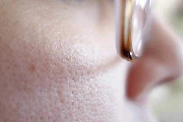 毛孔粗大要补水还是控油 毛孔粗大要补水还是控油