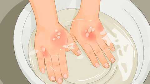 烫伤可以涂芦荟吗 烫伤可以涂芦荟吗