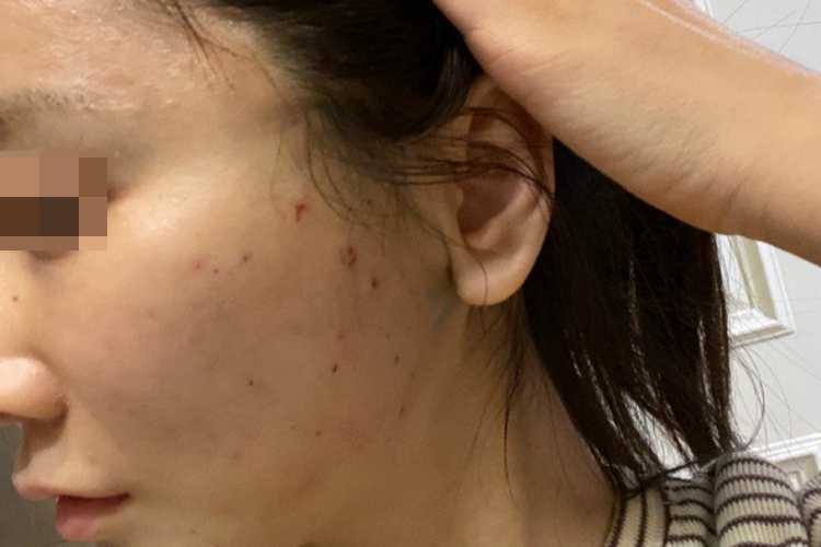 面部微雕一次一般多少钱？面部线雕一到7天图片