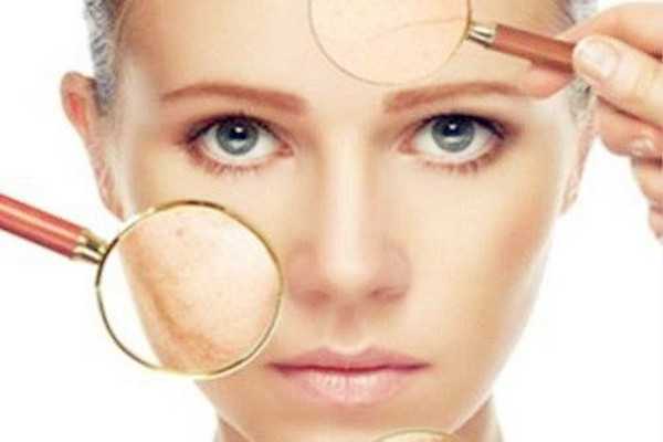 晒斑是如何形成的 晒斑是如何形成的