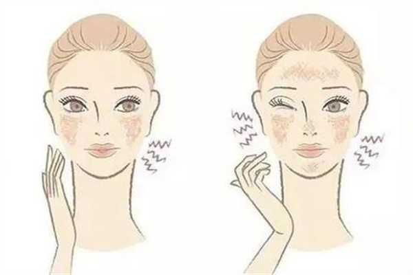 敏感肌可以涂防晒吗?敏感肌涂防晒霜会过敏吗 敏感肌可以涂防晒吗?敏感肌涂防晒霜会过敏吗