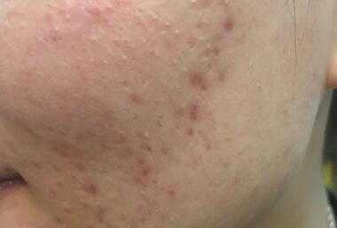 为什么换季时老出现痘痘 换季爆痘怎么办.jpg