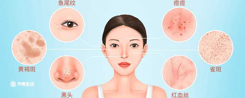 怎么去脸部黑头