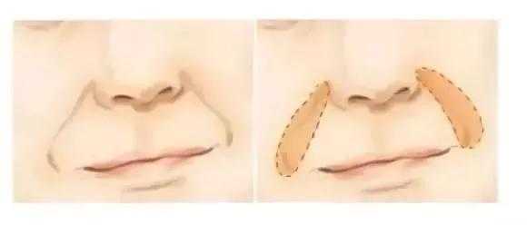 嘴角两边的纹叫什么纹