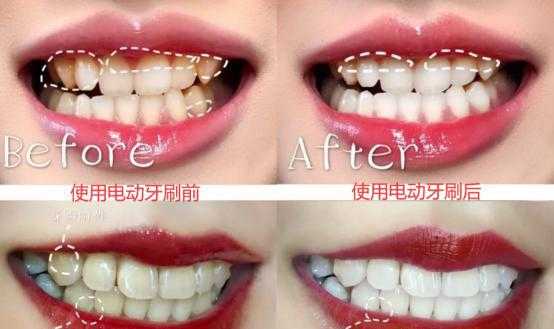 牙医为啥不建议用电动牙刷
